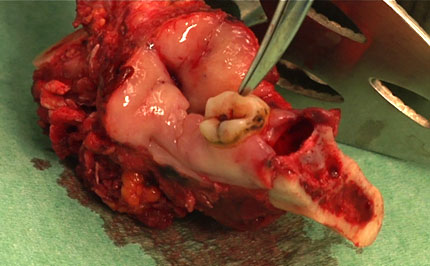 Resected mandibular bone segment