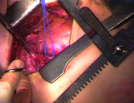 Video still (lobectomy) from a surgical light camera