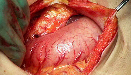 The stomach exposed through the midline incision.